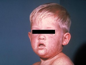 measles